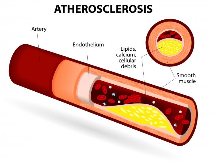 atherosclerosis.jpg